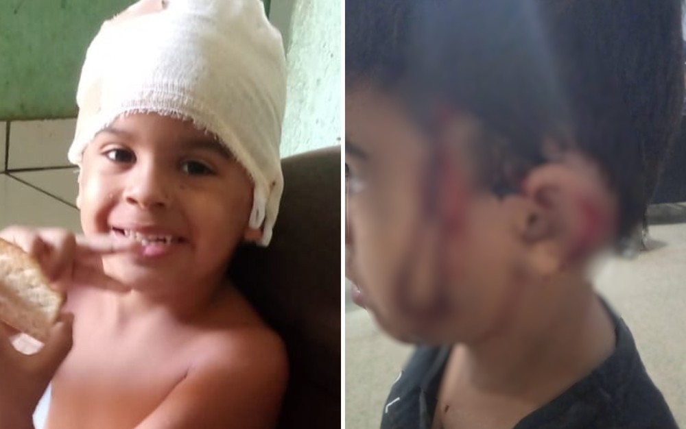 Menino perde parte da orelha ao ser atacado por cachorra enquanto passeava com a mãe, em Aparecida de Goiânia