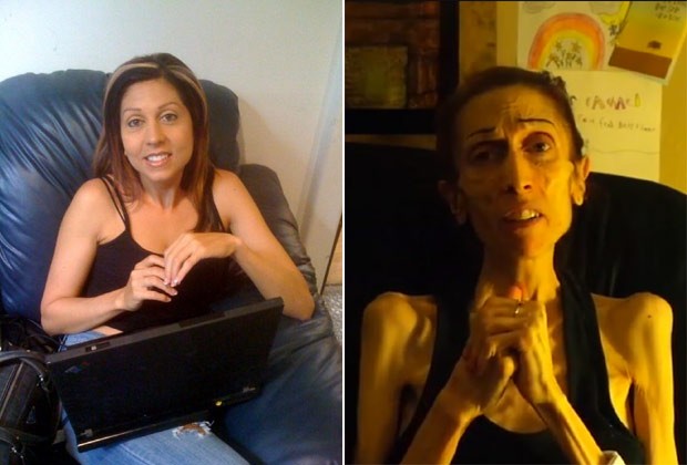 À esquerda, Rachael Farrokh antes da doença e à direita, a atriz agradecendo as doações para que possa tratar a anorexia nervosa (Foto: Reprodução / Facebook e YouTube)