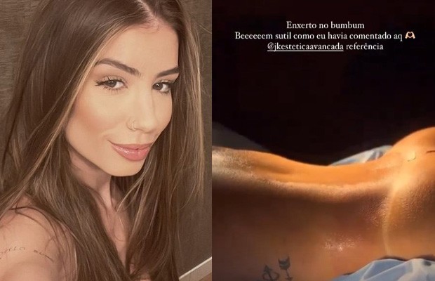 Jenny Miranda mostra antes e depois e harmonização facial feita