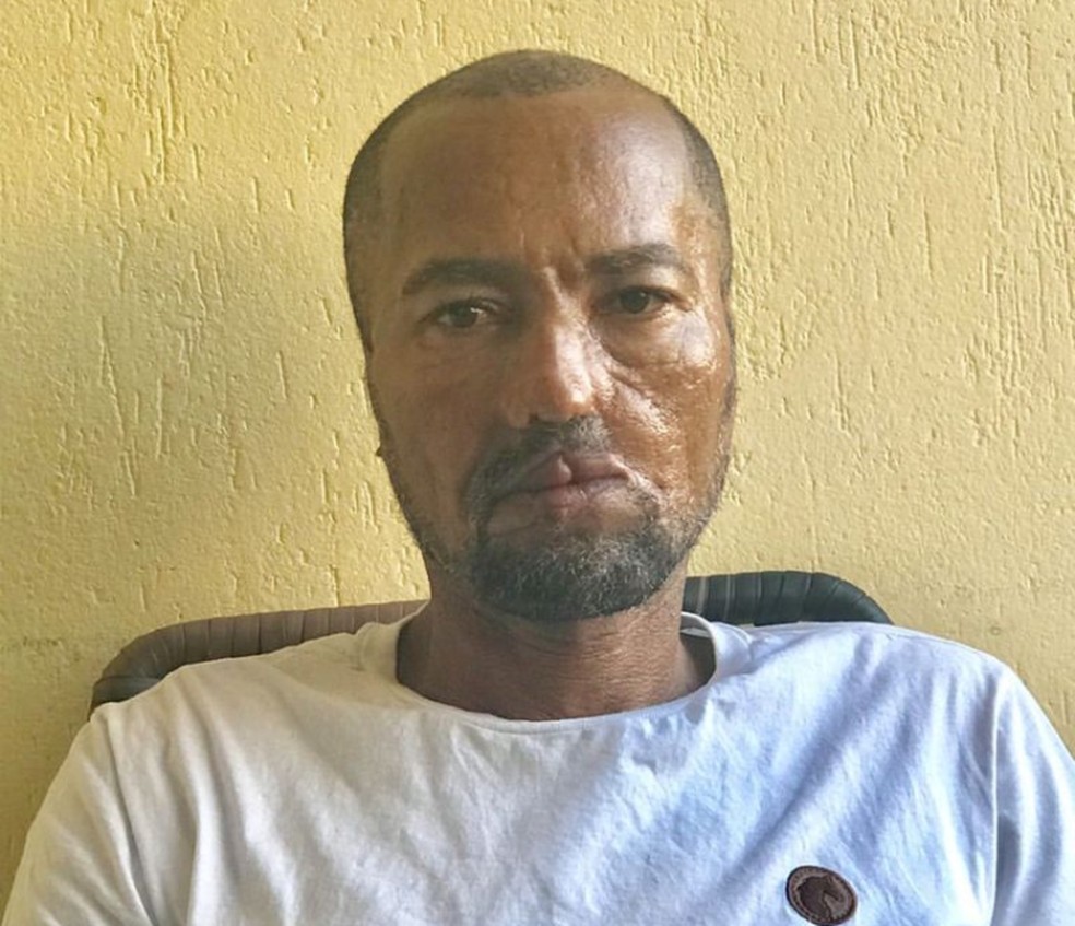 Baiano relata ataque de cães e pede ajuda para realizar cirurgia de reconstrução facial — Foto: Arquivo Pessoal