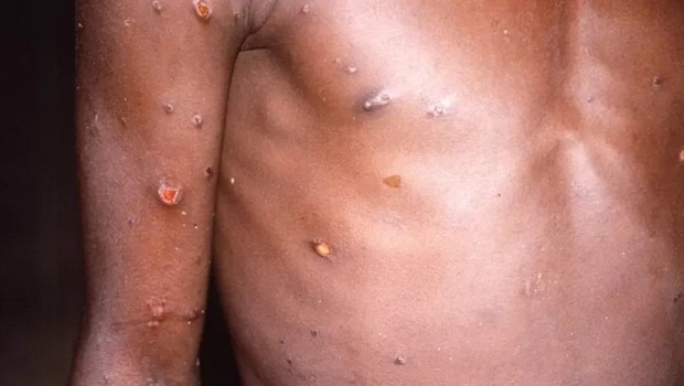 Braços e tronco de um paciente com lesões de pele devido à varíola dos macacos (Foto: REUTERS via BBC)