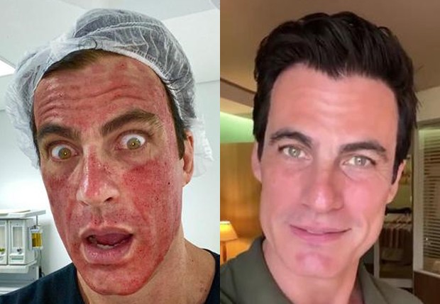 Antes e depois do tratamento a laser para manchas faciais