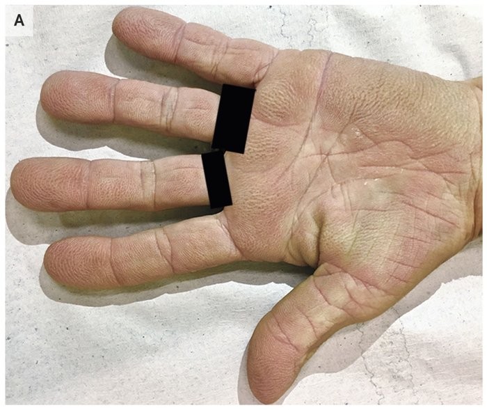 Condição "mãos de veludo" é caracterizada por lesões dolorosas nas palmas das mãos (Foto: Miyashiro and Sanches, NEJM, 2019)