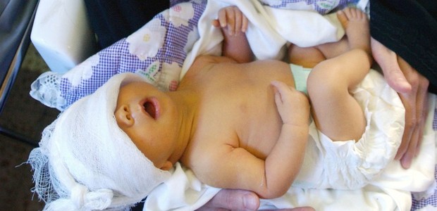 Bebê com icterícia (Foto: Getty Images)