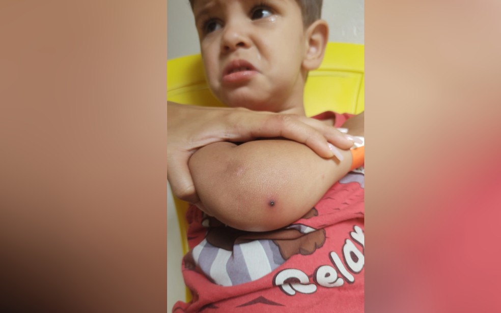 Marca da picada de aranha no braço de Miguel — Foto: Andressa Fernandes/Arquivo Pessoal
