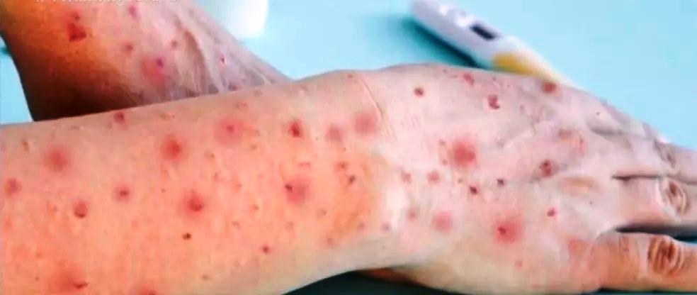 Baixada Santista tem 27 casos confirmados de varíola dos macacos