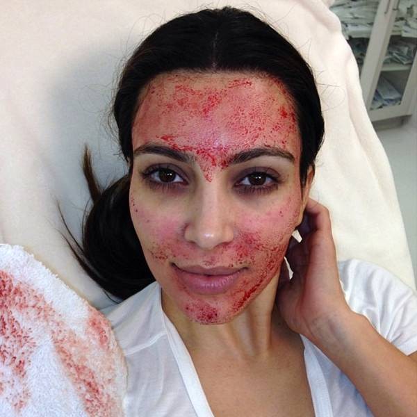 Kim Kardashian deu fama ao microagulhamento  (Foto: Reprodução/Instagram)