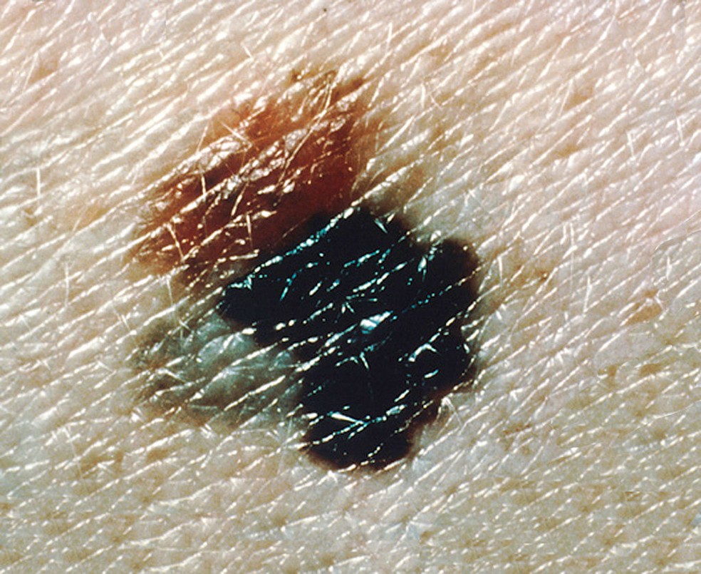 O melanoma representa apenas 5% dos casos de câncer de pele, mas tem uma grande capacidade de produzir metástases — Foto: https://commons.wikimedia.org/w/index.php?curid=24053016
