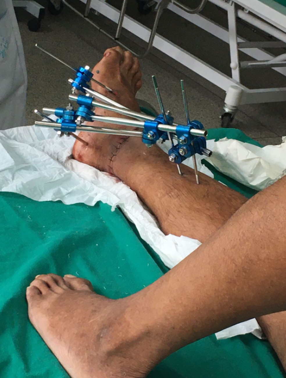 Idoso deve passar por segunda cirurgia — Foto: Arquivo pessoal