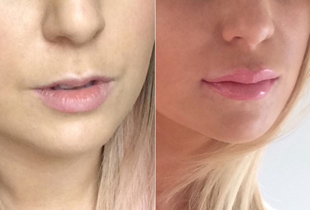 Os lábios de Chloe antes e depois (Foto: Reprodução/Marie Claire EUA)