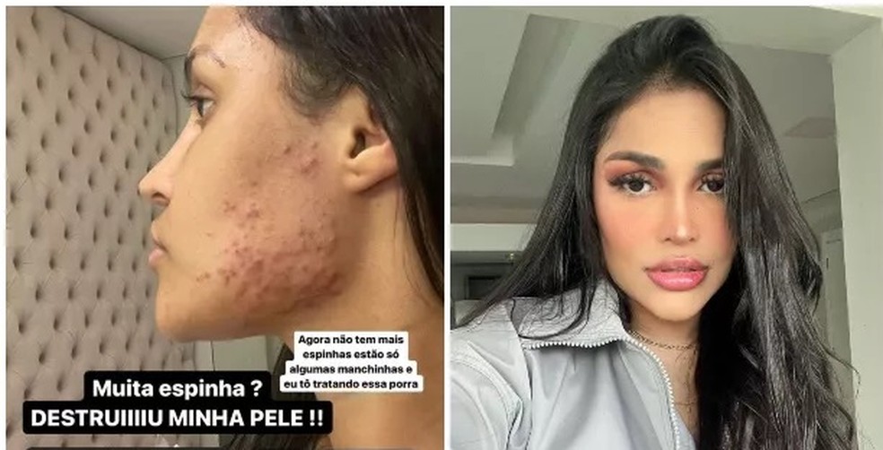 Flay mostra pele com acne após uso do chip da beleza — Foto: Reprodução/Instagram