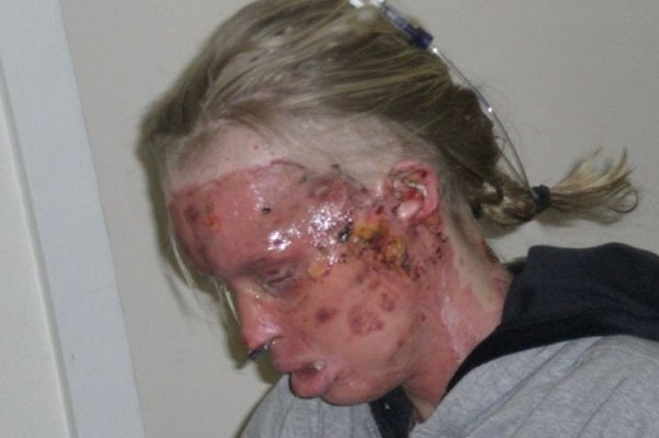 A modelo Katie Piper em 2008, quando sofreu um ataque de ácido arquitetado pelo seu ex-namorado (Foto: Instagram)