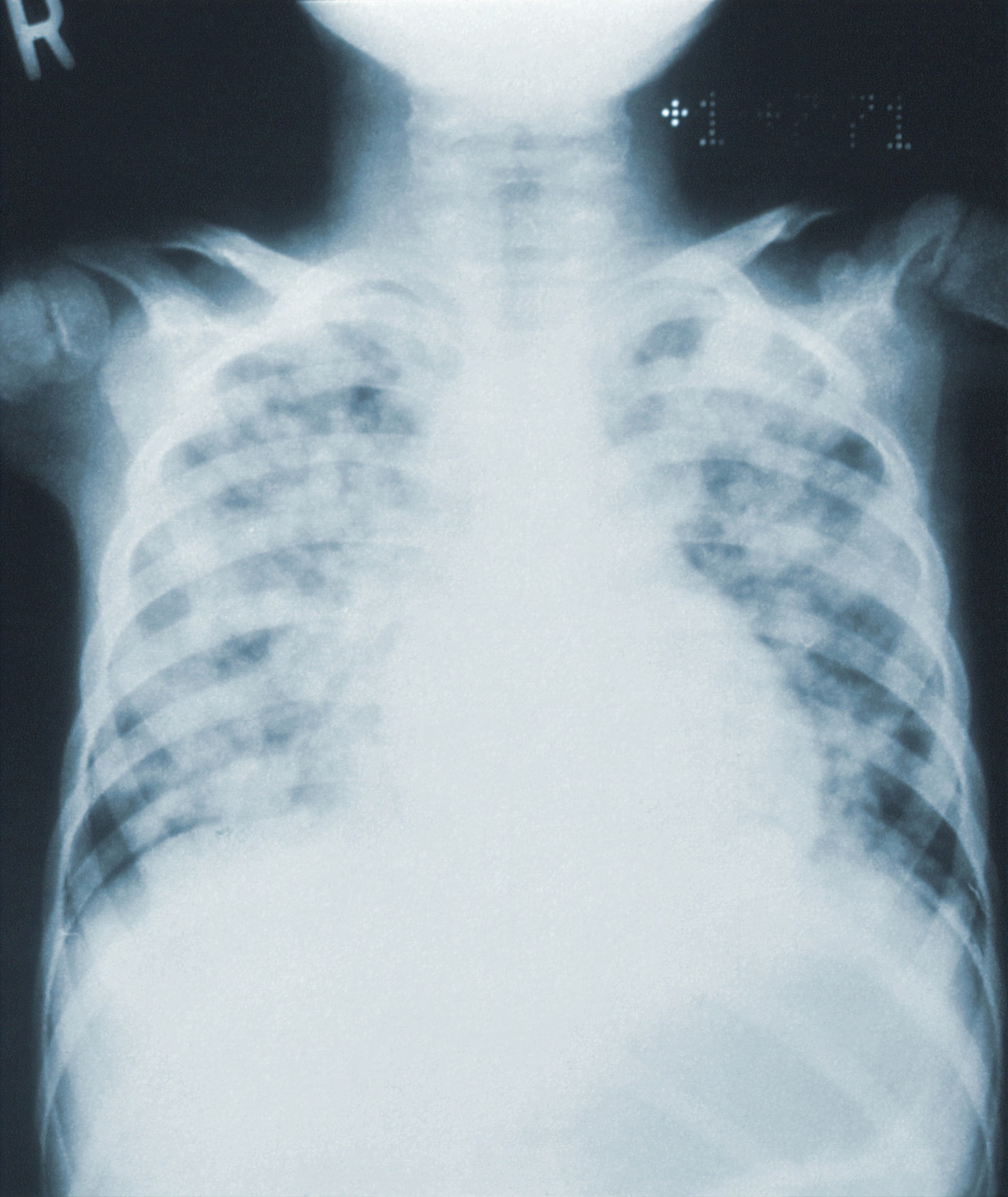 Raio-x mostra pneumonia (Foto: CDC/Unsplash)