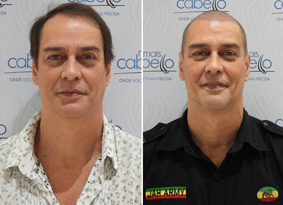 Marcello Antony antes e depois de fazer transplante capilar (Foto: Daniel Melo/Divulgação)