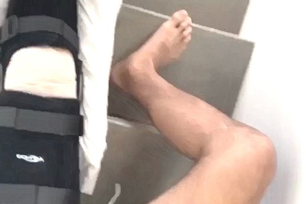 O ator Noah Centineo mostrando o joelho deslocado (Foto: Instagram)