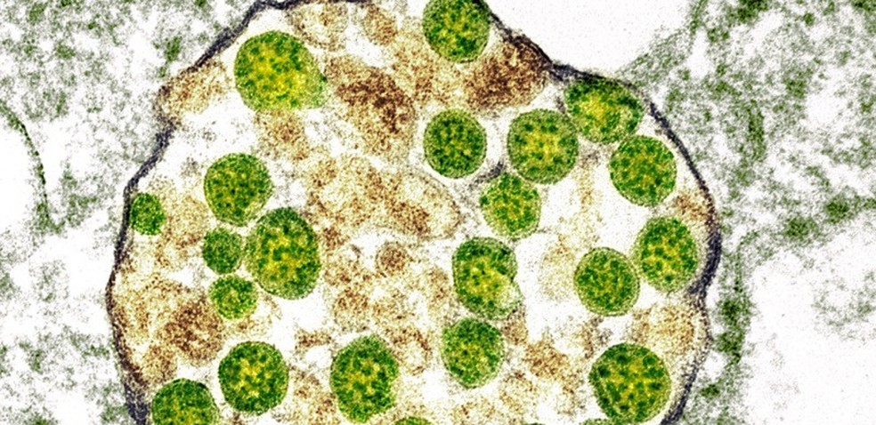 Imagem de célula infectada pelo coronavírus Sars-Cov-2  — Foto: Cynthia Goldsmith e Azaibi Tamin/CDC