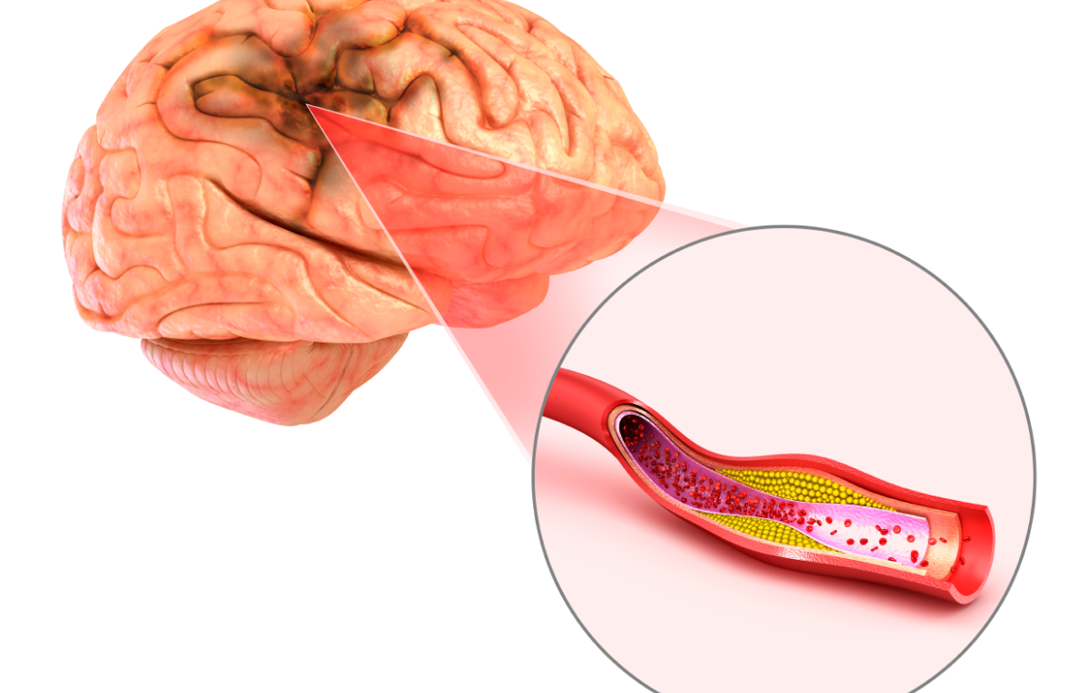 Saiba quais são os sintomas do AVC e o que fazer se alguém próximo sofrer um acidente vascular