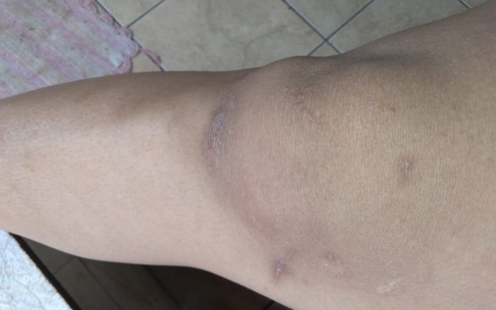 Marcas de cicatrizes após cortes na perna, em Rio Verde, Goiás — Foto: Shakira Costa/Arquivo pessoal