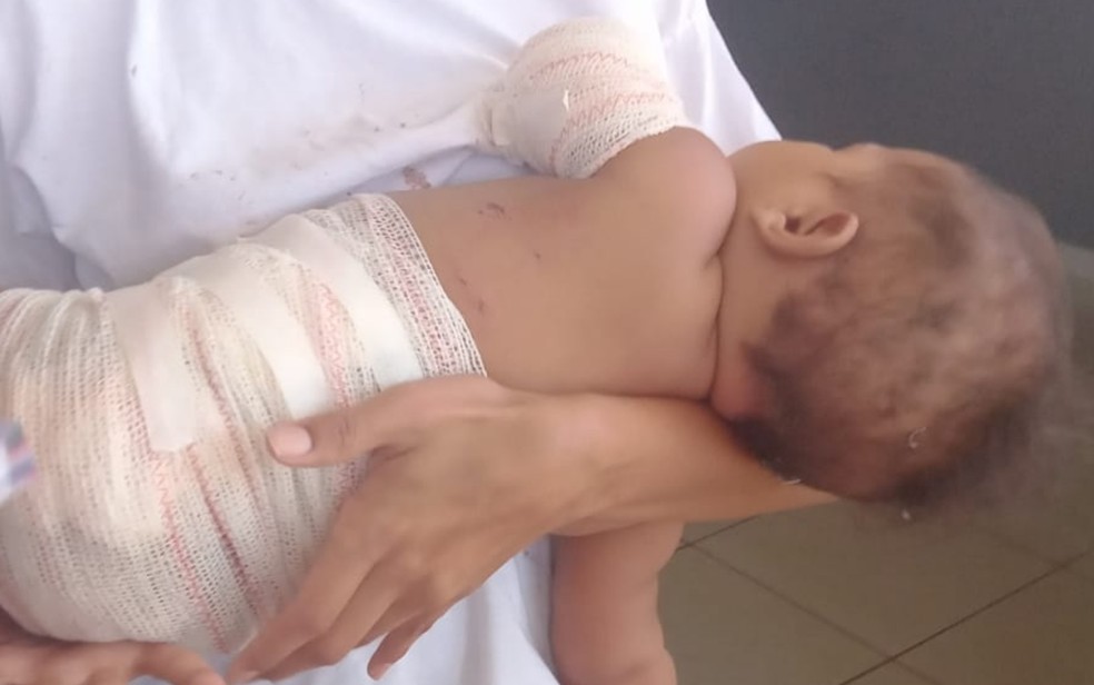 Bebê fica com queimaduras após ser atingida por rojão em Uruaçu — Foto: Luciana Guimarães/Arquivo Pessoal
