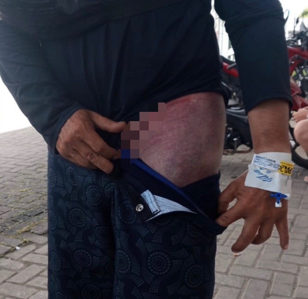 Músico mostra hematomas na perna enquanto aguardava do lado de fora da UPA sem atendimento após receber alta administrativa. — Foto: Cortesia