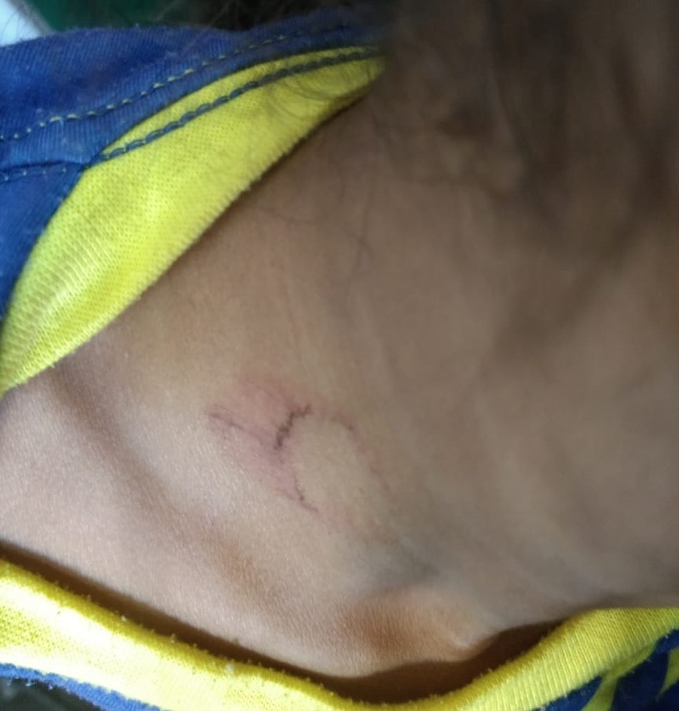 Criança vítima de tortura e estupro em Canhotinho também apresentava queimadura no pescoço — Foto: Polícia Civil/Divulgação
