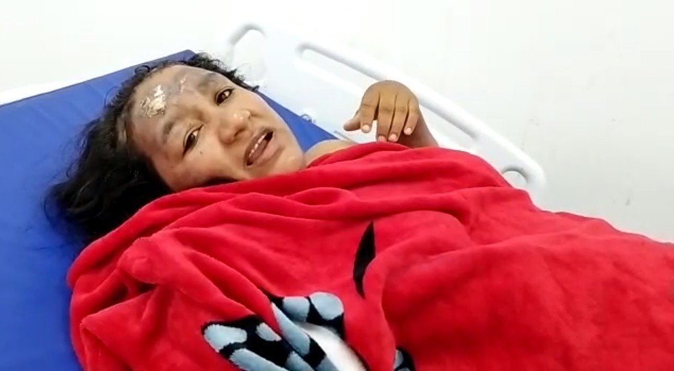 Leidiana da Silva sofreu lesões de 1º e 2º graus no rosto, pescoço, tórax e região posterior dos flancos — Foto: Reprodução
