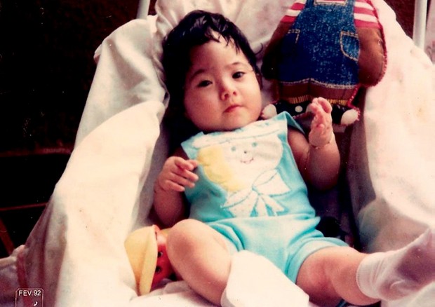 Ana Carolina Dias depois da primeira cirurgia, aos 12 meses (Foto: Arquivo Pesoal)