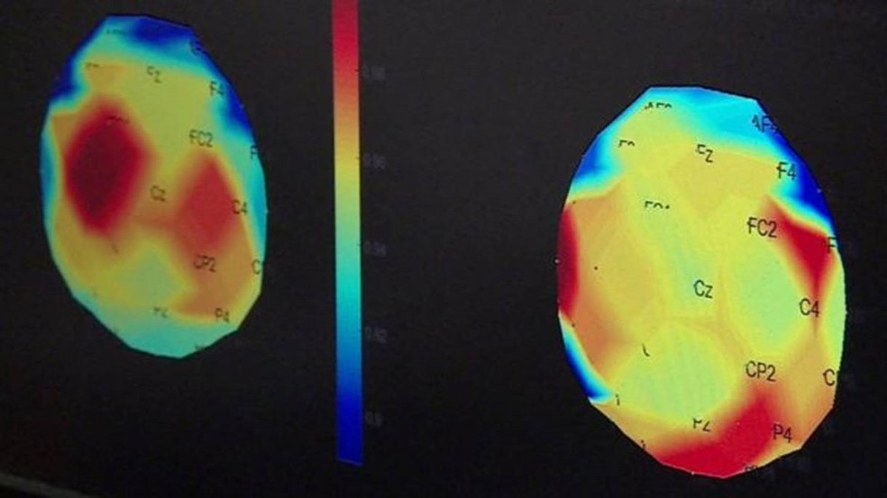 Partes do cÃ©rebro responsÃ¡veis pelos movimentos (em vermelho na imagem da esquerda) nÃ£o estavam funcionando adequadamente. ApÃ³s trÃªs meses de tratamento, essas regiÃµes foram reativadas â€” Foto: BBC NEWS/WESTERN UNIVERSITY