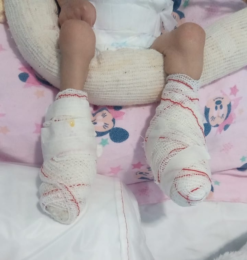 Bebê sofre queimadura nos pés após hospital esquecer aquecedor ligado em Jacareí; família acusa hospital de negligência. — Foto: Arquivo pessoal