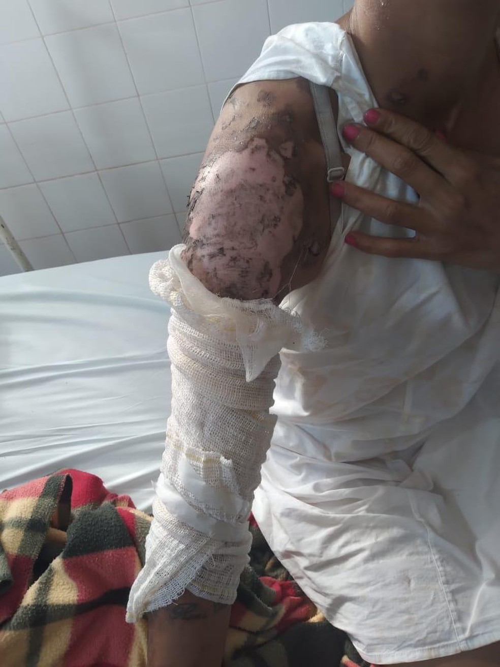 Mulher sofreu queimaduras pelo corpo após ser jogada em uma fogueira de uma festa junina realizada neste domingo (27) em um sítio na zona rural de Dom Aquino (MT) — Foto: PMMT