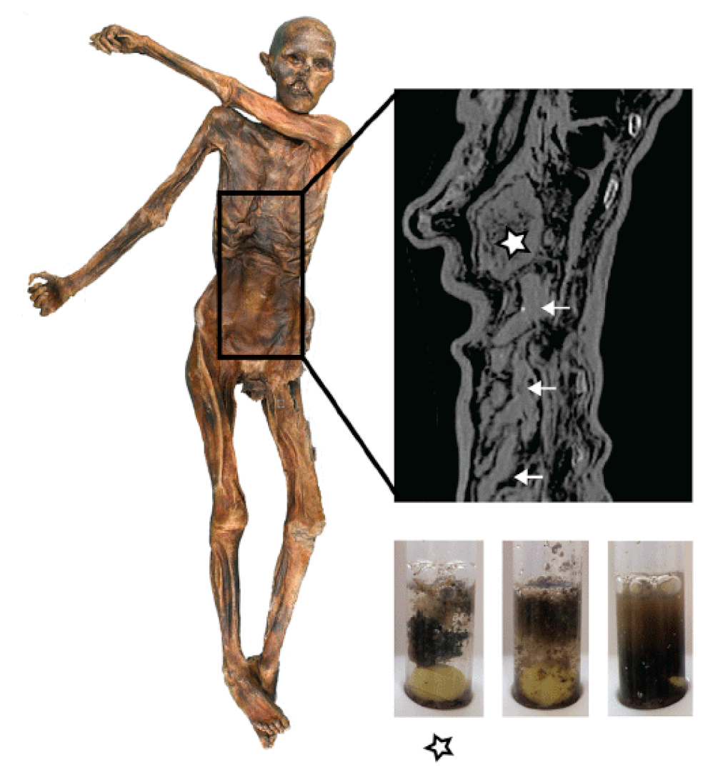 Imagem do trato digestivo do Homem de Gelo - estômago só foi localizado em exames 18 anos após a descoberta da múmia (Foto: Institute for Mummy Studies/Eurach Research/Frank M)
