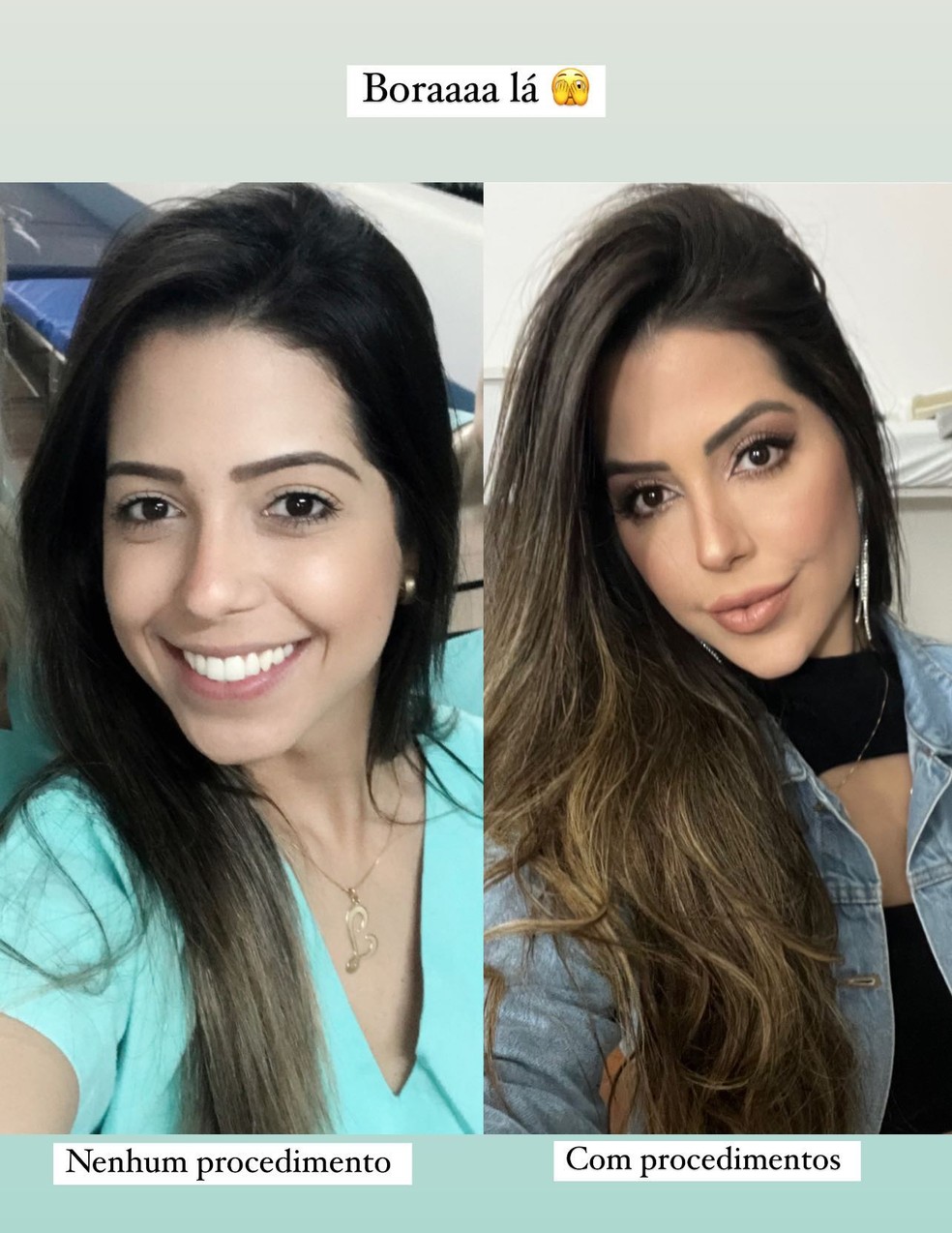 Antes e depois de Laís Caldas — Foto: Reprodução/Instagram