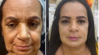 Antes e depois da harmonização facial da Gaguinha de Ilhéus — Foto: Reprodução/Instagram