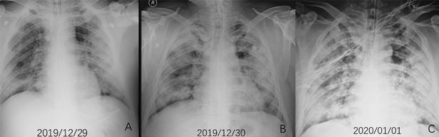 Deterioração do pulmão de uma vítima do coronavírus que trabalhava perto do local onde a doença teve origem (Foto: Radiological Society of North America (RSNA))