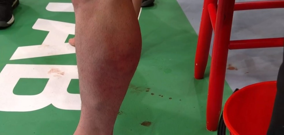 Detalhe da perna de Luke Jumeau no intervalo da luta contra Dhiego Lima no UFC 243 — Foto: Reprodução / Combate