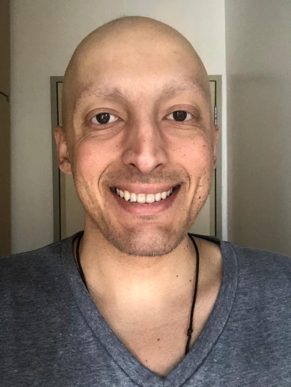 O cineasta teve duas recidivas do câncer, precisou fazer quimioterapia oral e intravenosa, perdeu peso e chegou a raspar o cabelo — Foto: Arquivo pessoal/ Reprodução