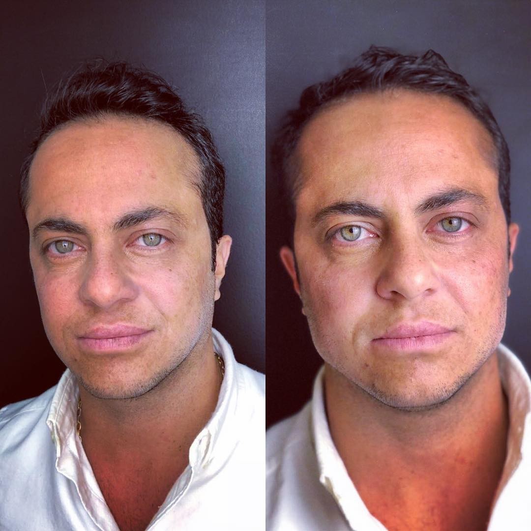 Thammy Miranda mostra antes e depois de procedimento estético (Foto: Reprodução)