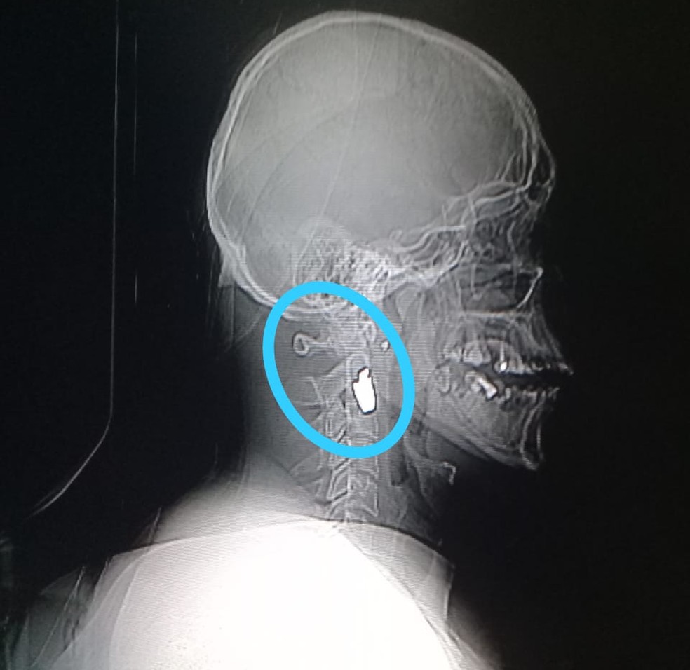 Bala ficou alojada no pesco&ccedil;o da v&iacute;tima &mdash; Foto: Arquivo Pessoal