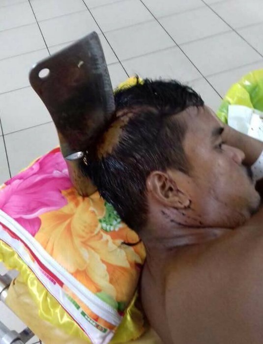 Homem tem cutelo cravado na cabeÃ§a no Camboja
