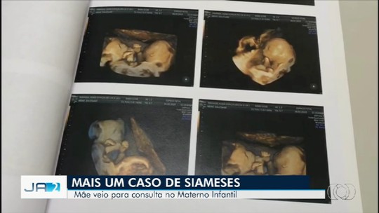 Grávida de siameses vinda do Espírito Santo passa por primeira consulta em Goiás 