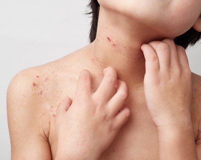 Casos de alergia em crianças aumentaram 7 vezes nos últimos 15 anos, diz pesquisa