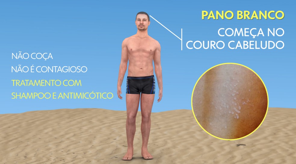 Calor E Umidade Favorecem O Aparecimento De Micose Bem Estar G1