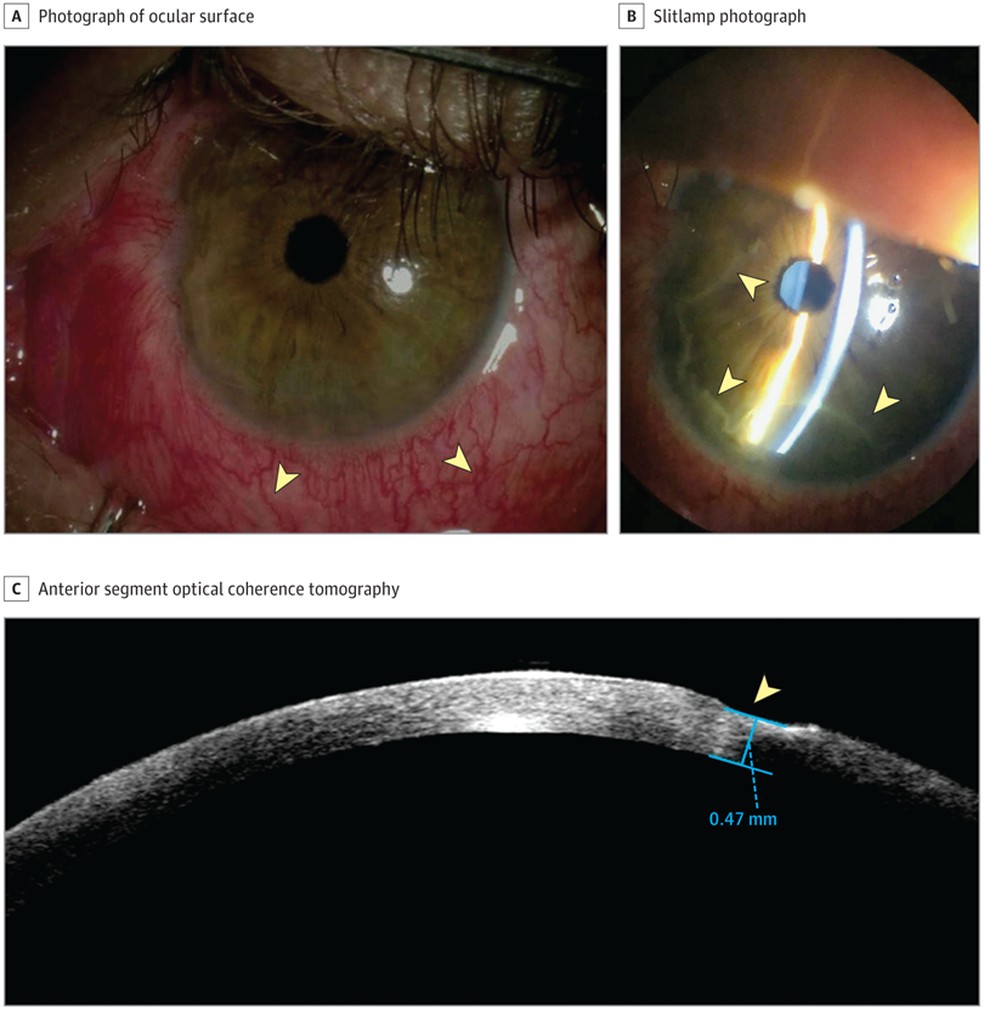 Imagens do primeiro caso de inflamação ocular por Mpox — Foto: JAMA Ophthalmol