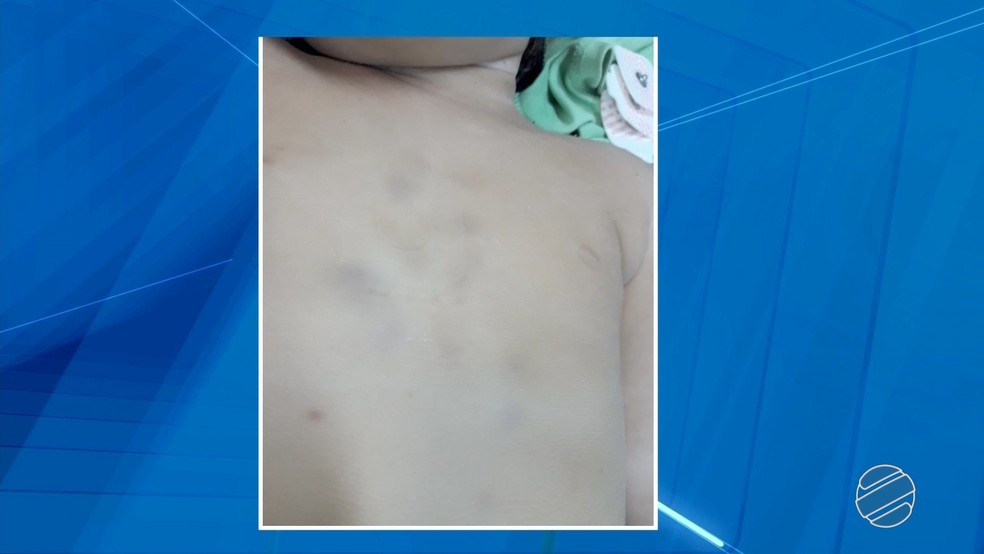 Hematomas pelo corpo de Rian Vinícius que morreu horas depois de chegar ao hospital de Corumbá (MS) (Foto: Reprodução/TV Morena)