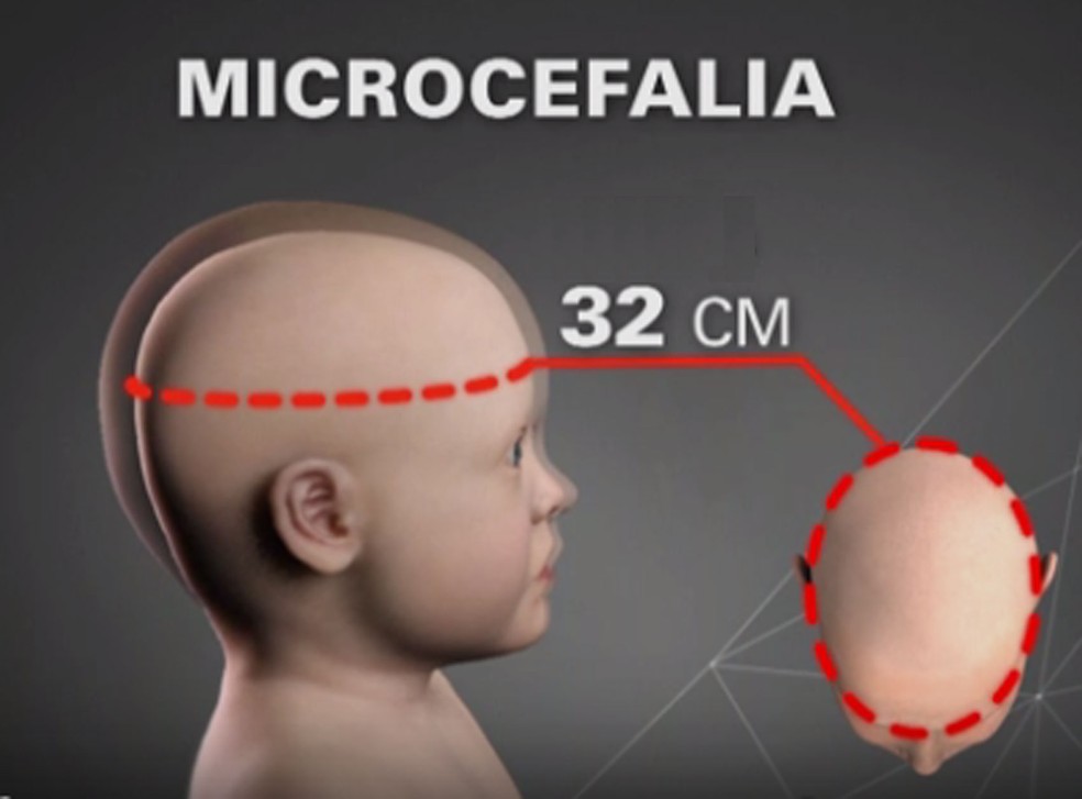 Bebê com circunferência do crânio menor que 32 centímetros é considerado portador de microcefalia — Foto: Reprodução/TV Globo