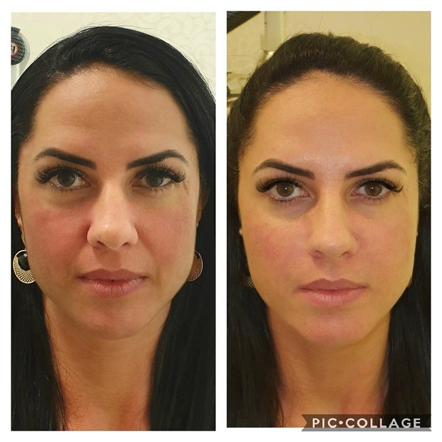 Antes e depois de Graciele Lacerda com harmonização facial (Foto: Reprodução/Instagram)