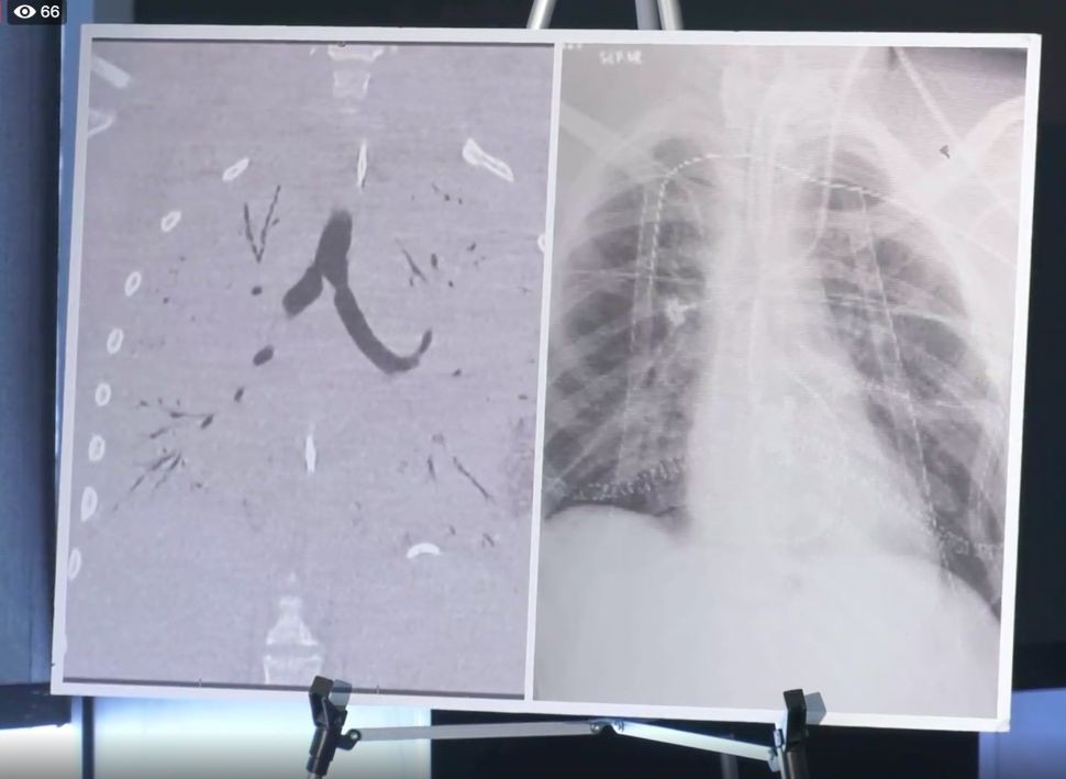 Tomografia original do paciente (à esquerda) revelou tecido pulmonar extremamente danificado que continha pouco ar. Os pulmões transplantados (à direita) possuem a borda mais preta, indicando que o órgão está cheio de ar, como deveria (Foto:  Henry Ford Hospital Detroir)