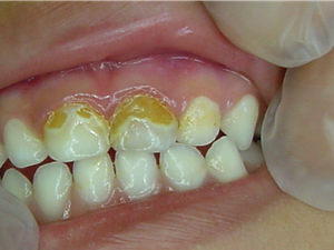 Nanopartículas de prata deixam dente amarelado no início, mas depois eles voltam a ficar brancos (Foto: Divulgação / Cetene)