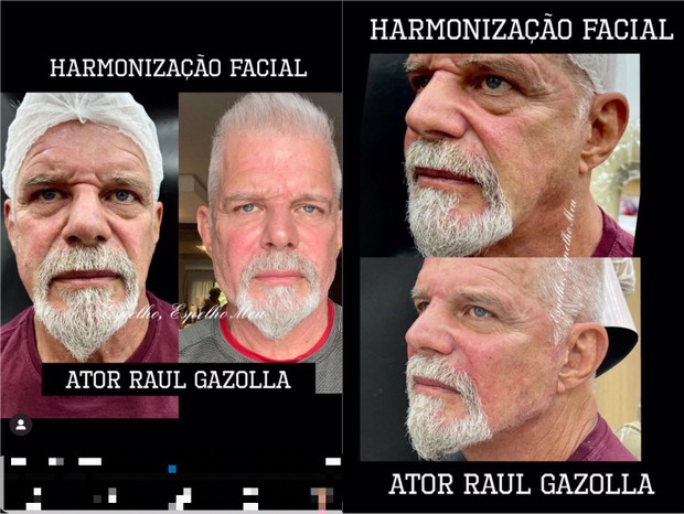 Antes e depois de Raul Gazolla (Foto: Reprodução/Instagram)