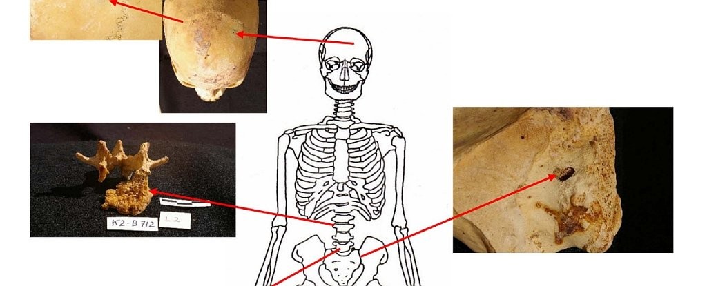 Sinais de câncer nos esqueletos egípcios.  (Foto: Molto and Sheldrick/International Journal of Paleopathology)